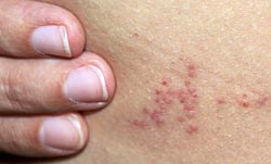 Dealing with bedbugs | Eyeflare.com